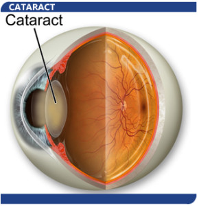 cataract3