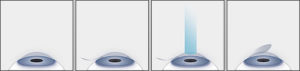 LASIK
