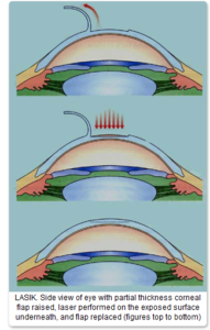 lasik